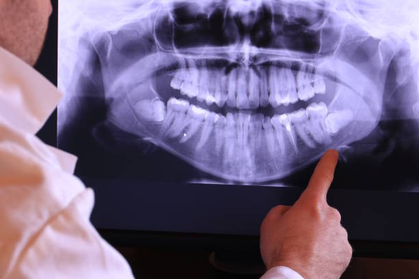 Best Emergency Dentist for Lost Fillings or Crowns in Milan, TN